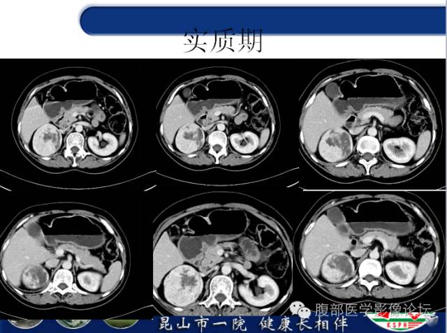 【病例】胃神经内分泌癌+右肾透明细胞癌1例CT
