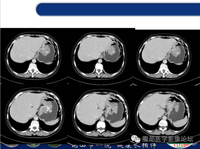 【病例】胃神经内分泌癌+右肾透明细胞癌1例CT