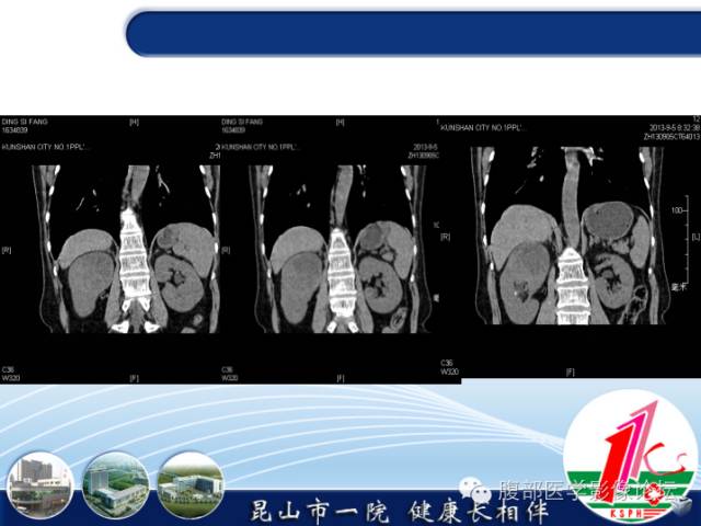 【病例】胃神经内分泌癌+右肾透明细胞癌1例CT