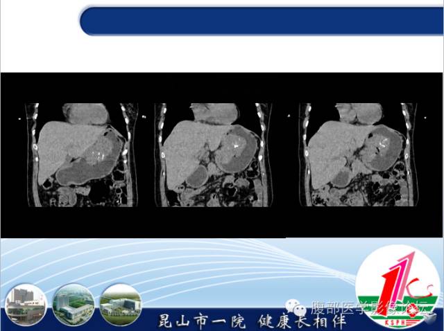 【病例】胃神经内分泌癌+右肾透明细胞癌1例CT