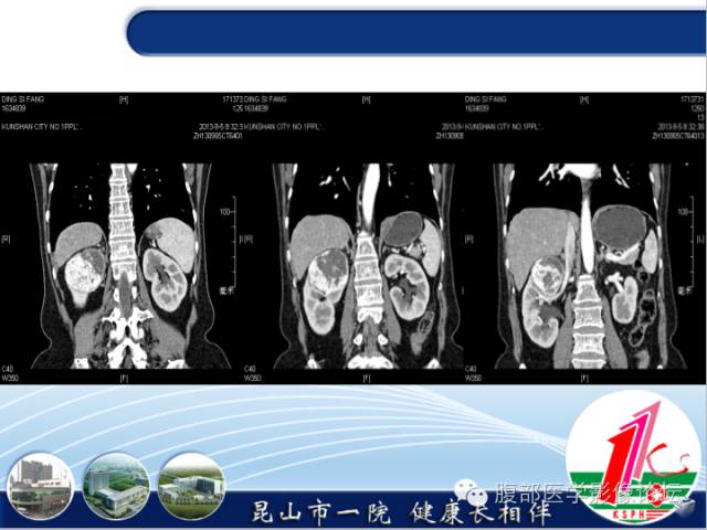 【病例】胃神经内分泌癌+右肾透明细胞癌1例CT
