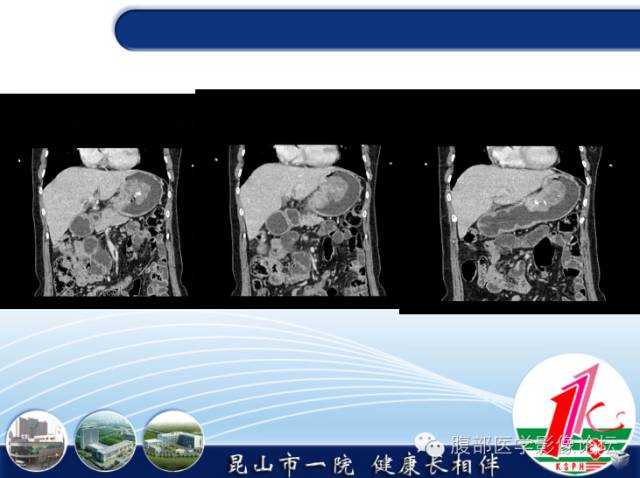 【病例】胃神经内分泌癌+右肾透明细胞癌1例CT