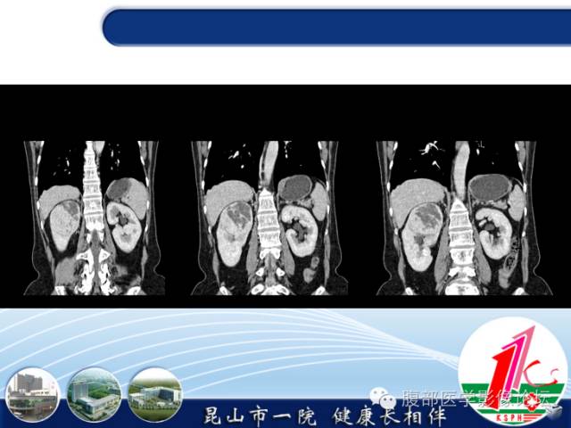 【病例】胃神经内分泌癌+右肾透明细胞癌1例CT