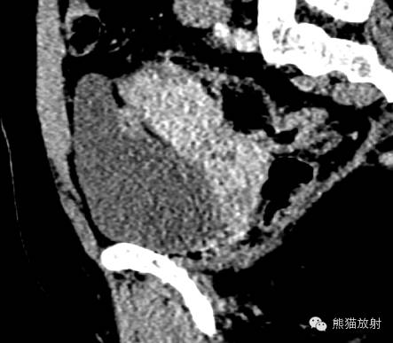【病例】罕少见的子宫内膜异位症3例,需警惕! 【病例】罕少见的子宫内膜异位症3例,需警惕!