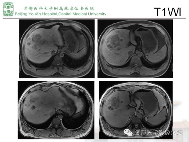 【病例】肝腺瘤1例MR影像表现