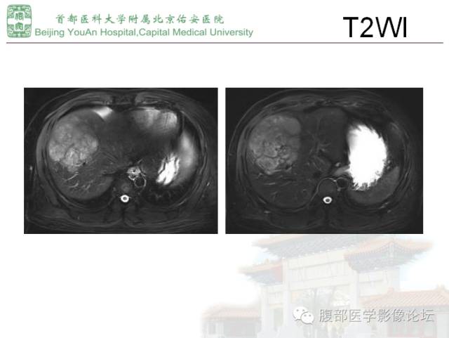 【病例】肝腺瘤1例MR影像表现