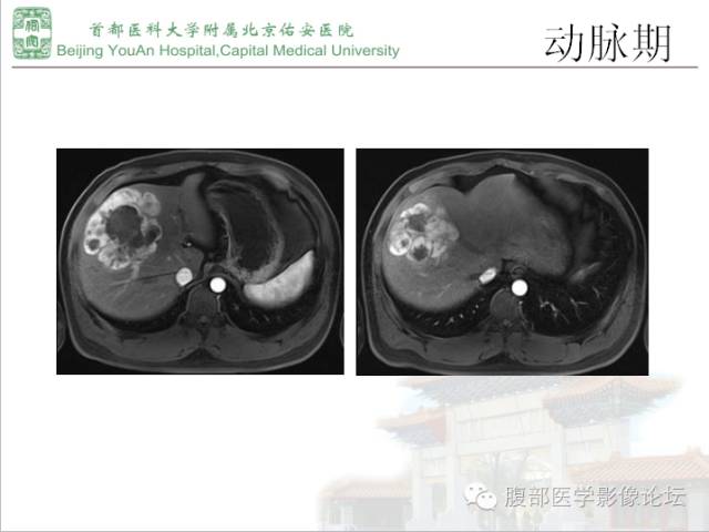 【病例】肝腺瘤1例MR影像表现