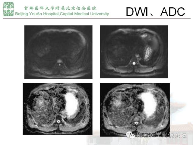 【病例】肝腺瘤1例MR影像表现