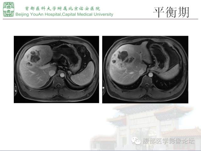 【病例】肝腺瘤1例MR影像表现