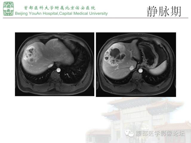 【病例】肝腺瘤1例MR影像表现