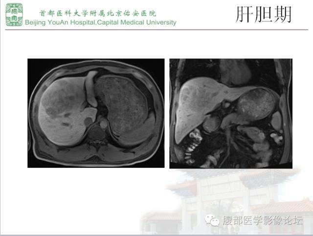 【病例】肝腺瘤1例MR影像表现
