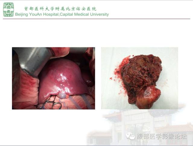 【病例】肝腺瘤1例MR影像表现