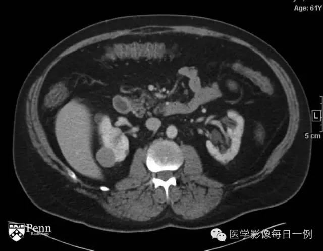 【病例】右肾乳头状肾细胞癌1例CT及MR影像表现 【病例】右肾乳头状肾细胞癌1例CT及MR影像表现