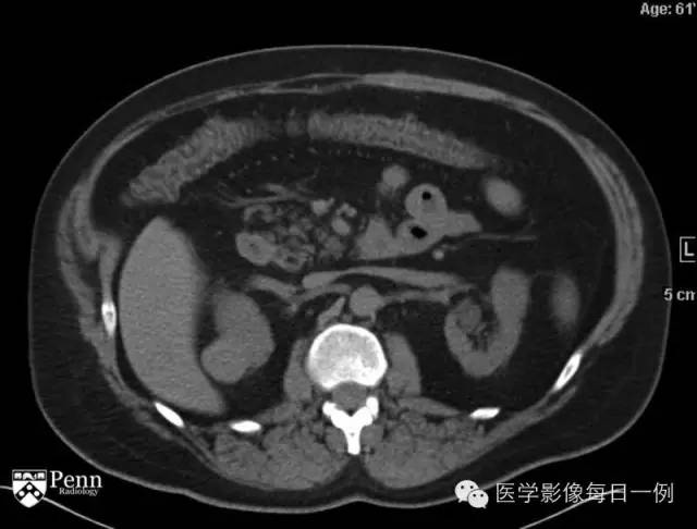 【病例】右肾乳头状肾细胞癌1例CT及MR影像表现
