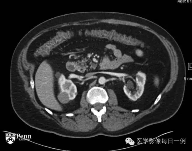 【病例】右肾乳头状肾细胞癌1例CT及MR影像表现 【病例】右肾乳头状肾细胞癌1例CT及MR影像表现