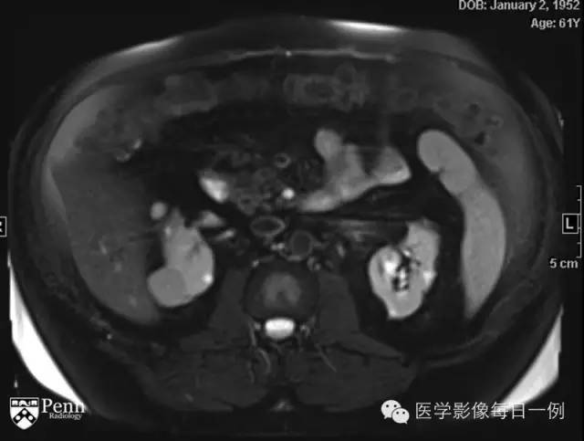 【病例】右肾乳头状肾细胞癌1例CT及MR影像表现 【病例】右肾乳头状肾细胞癌1例CT及MR影像表现