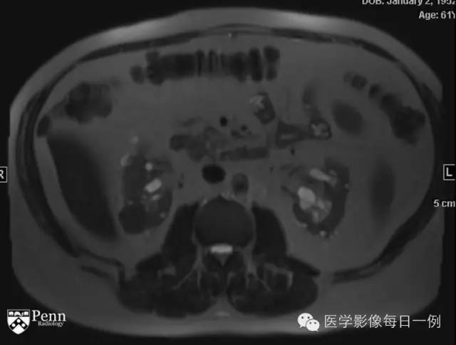 【病例】右肾乳头状肾细胞癌1例CT及MR影像表现 【病例】右肾乳头状肾细胞癌1例CT及MR影像表现