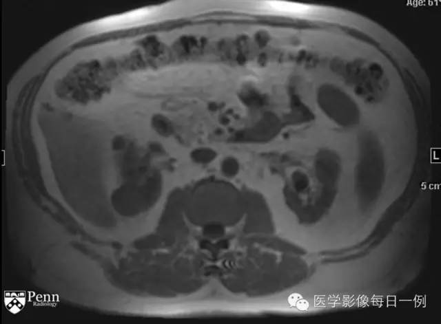 【病例】右肾乳头状肾细胞癌1例CT及MR影像表现 【病例】右肾乳头状肾细胞癌1例CT及MR影像表现