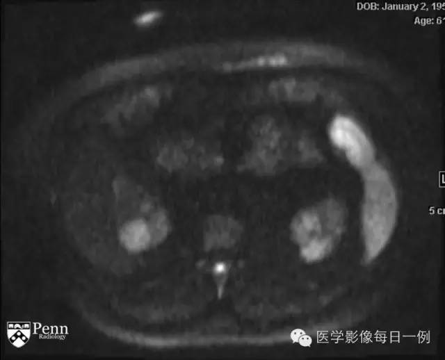 【病例】右肾乳头状肾细胞癌1例CT及MR影像表现 【病例】右肾乳头状肾细胞癌1例CT及MR影像表现