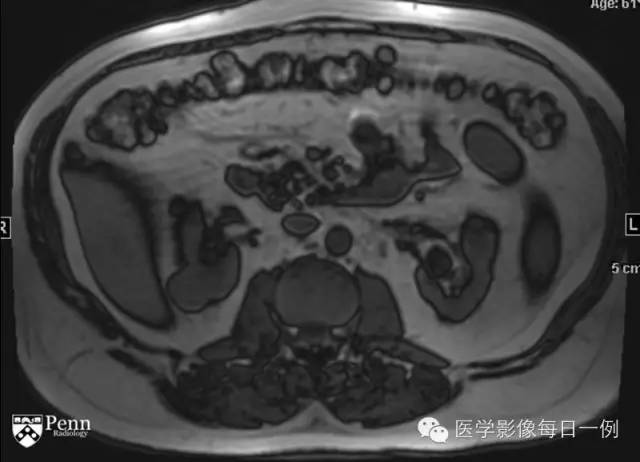 【病例】右肾乳头状肾细胞癌1例CT及MR影像表现 【病例】右肾乳头状肾细胞癌1例CT及MR影像表现
