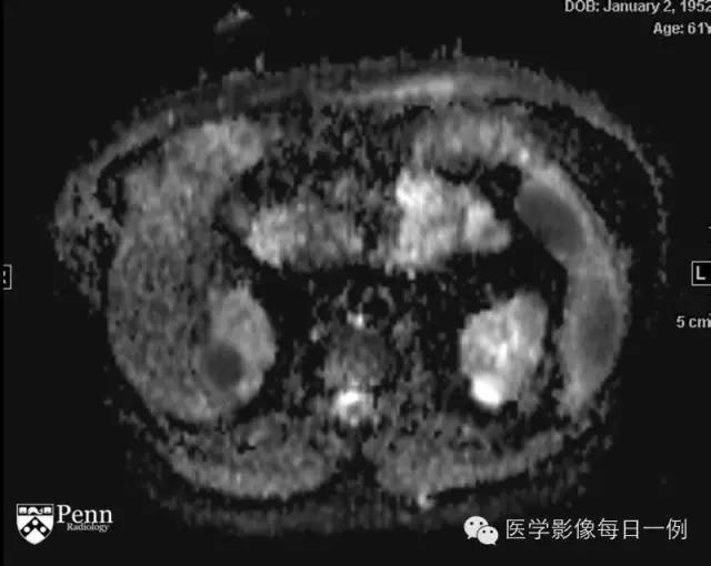 【病例】右肾乳头状肾细胞癌1例CT及MR影像表现 【病例】右肾乳头状肾细胞癌1例CT及MR影像表现