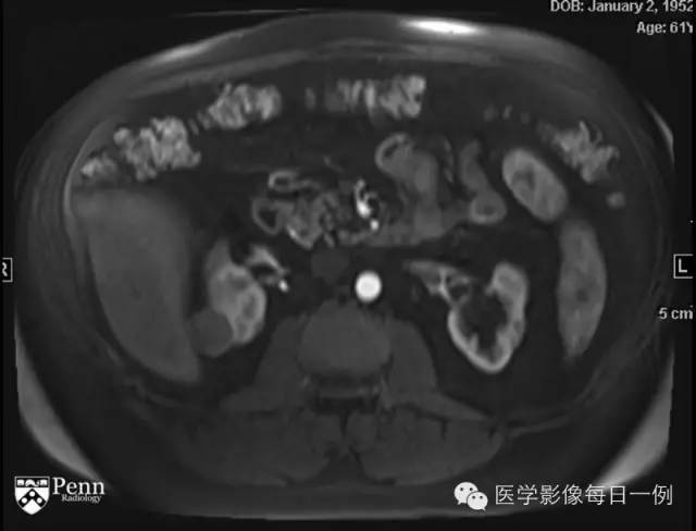 【病例】右肾乳头状肾细胞癌1例CT及MR影像表现 【病例】右肾乳头状肾细胞癌1例CT及MR影像表现