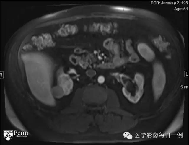 【病例】右肾乳头状肾细胞癌1例CT及MR影像表现 【病例】右肾乳头状肾细胞癌1例CT及MR影像表现