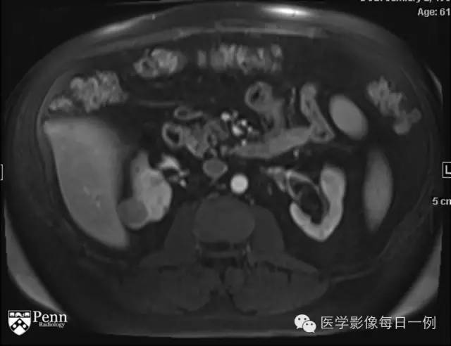 【病例】右肾乳头状肾细胞癌1例CT及MR影像表现 【病例】右肾乳头状肾细胞癌1例CT及MR影像表现