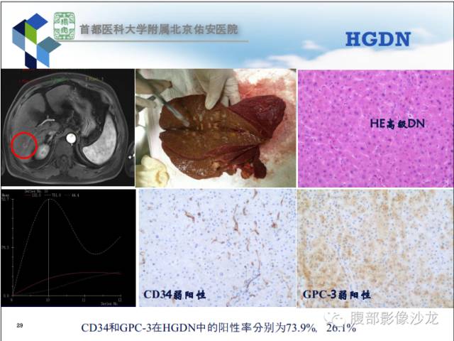 【PPT】HBV相关肝细胞癌演变MRI分级诊断