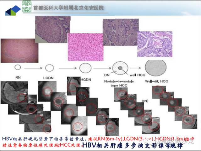 【PPT】HBV相关肝细胞癌演变MRI分级诊断