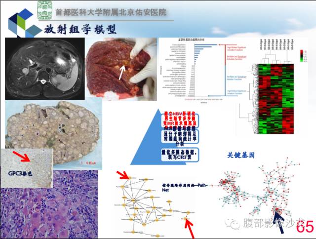 【PPT】HBV相关肝细胞癌演变MRI分级诊断