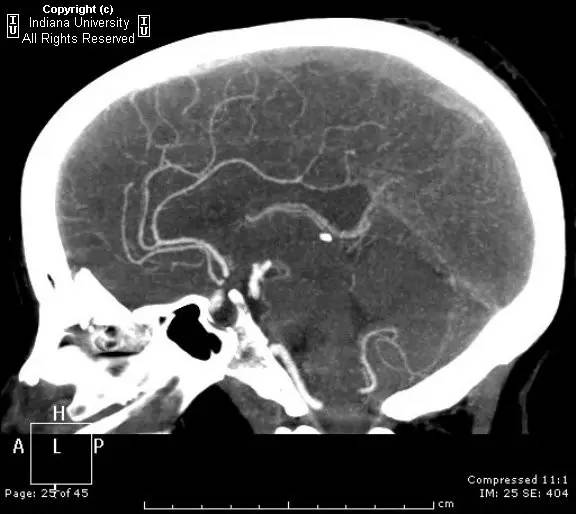 【病例】弥漫性中枢神经系统静脉窦血栓形成1例CT及MR影像表现 【病例】弥漫性中枢神经系统静脉窦血栓形成1例CT及MR影像表现