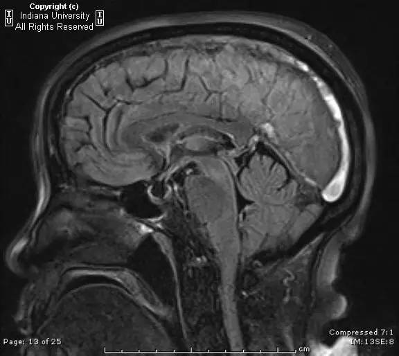 【病例】弥漫性中枢神经系统静脉窦血栓形成1例CT及MR影像表现 【病例】弥漫性中枢神经系统静脉窦血栓形成1例CT及MR影像表现