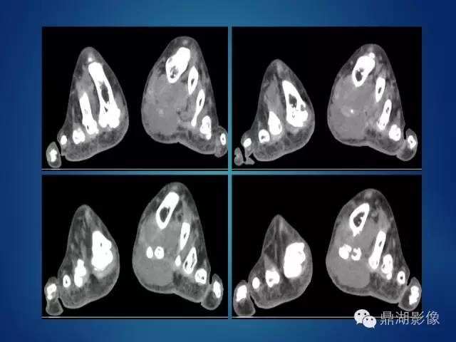 【病例】左足腱鞘巨细胞瘤1例CT及MR影像表现 【病例】左足腱鞘巨细胞瘤1例CT及MR影像表现