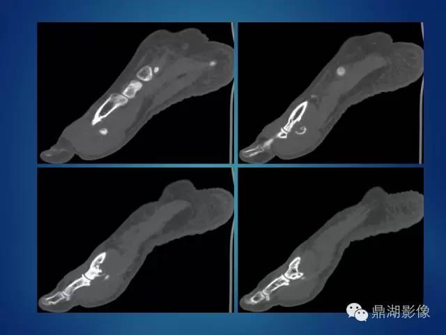 【病例】左足腱鞘巨细胞瘤1例CT及MR影像表现 【病例】左足腱鞘巨细胞瘤1例CT及MR影像表现