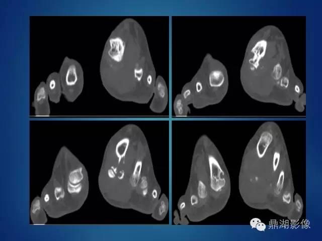 【病例】左足腱鞘巨细胞瘤1例CT及MR影像表现 【病例】左足腱鞘巨细胞瘤1例CT及MR影像表现