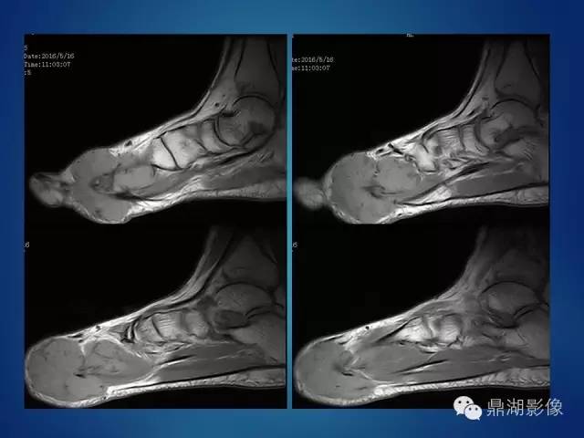 【病例】左足腱鞘巨细胞瘤1例CT及MR影像表现 【病例】左足腱鞘巨细胞瘤1例CT及MR影像表现