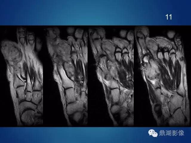 【病例】左足腱鞘巨细胞瘤1例CT及MR影像表现 【病例】左足腱鞘巨细胞瘤1例CT及MR影像表现