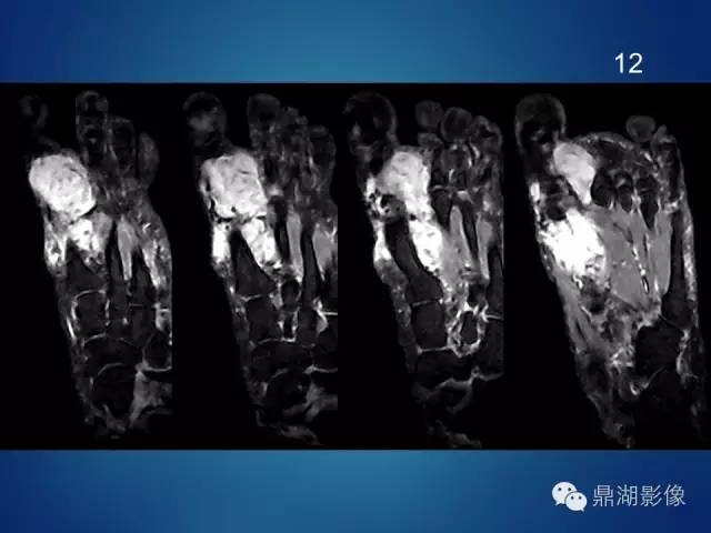 【病例】左足腱鞘巨细胞瘤1例CT及MR影像表现 【病例】左足腱鞘巨细胞瘤1例CT及MR影像表现