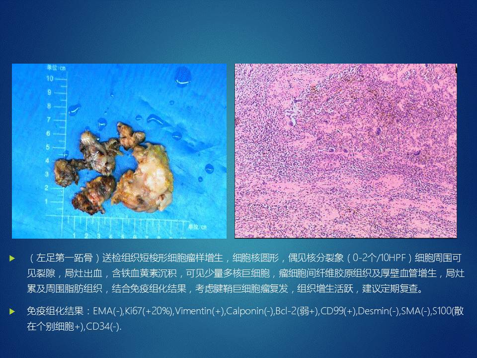 【病例】左足腱鞘巨细胞瘤1例CT及MR影像表现 【病例】左足腱鞘巨细胞瘤1例CT及MR影像表现