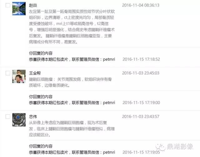 【病例】左足腱鞘巨细胞瘤1例CT及MR影像表现 【病例】左足腱鞘巨细胞瘤1例CT及MR影像表现