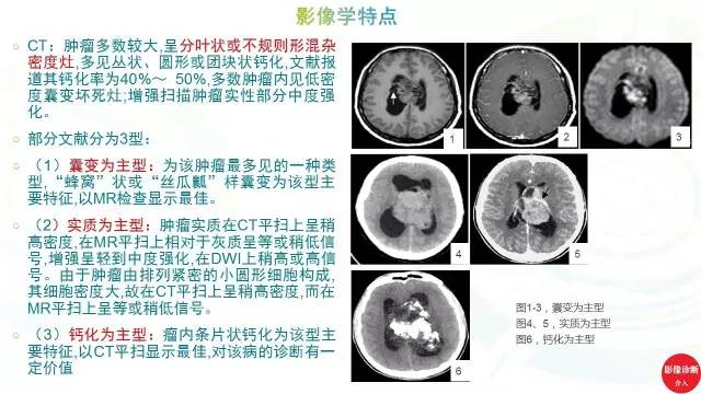 【PPT】中枢神经细胞瘤影像诊断及鉴别诊断