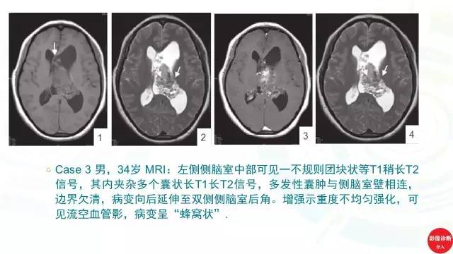 【PPT】中枢神经细胞瘤影像诊断及鉴别诊断