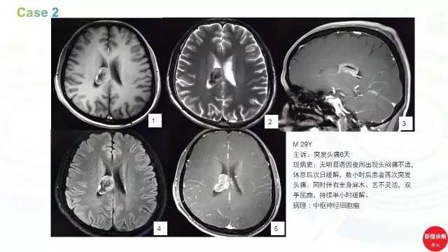【PPT】中枢神经细胞瘤影像诊断及鉴别诊断