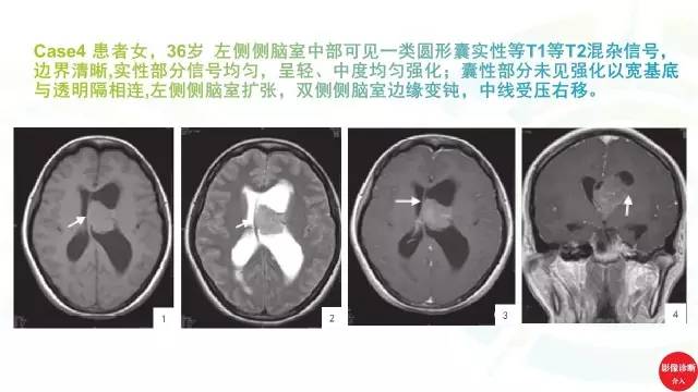【PPT】中枢神经细胞瘤影像诊断及鉴别诊断