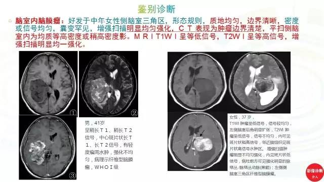【PPT】中枢神经细胞瘤影像诊断及鉴别诊断
