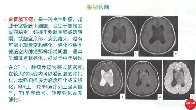 【PPT】中枢神经细胞瘤影像诊断及鉴别诊断