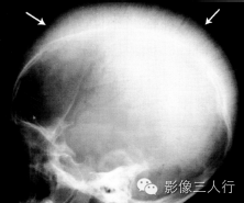 "发丝征"，这个征象提示啥？