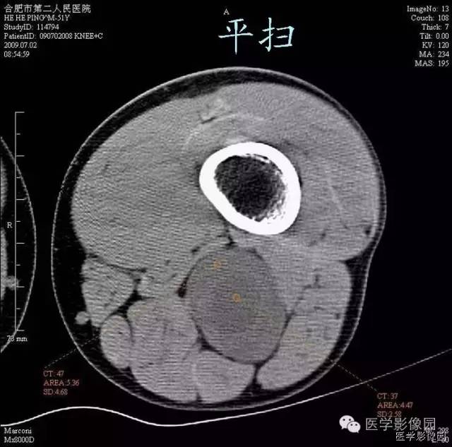 【病例】腘窝上方神经鞘瘤1例CT影像表现