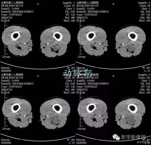【病例】腘窝上方神经鞘瘤1例CT影像表现 【病例】腘窝上方神经鞘瘤1例CT影像表现